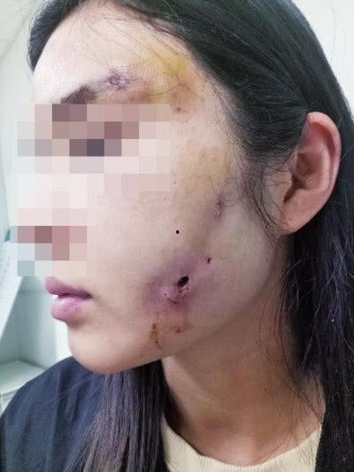 郑州整形失败爆料案件最新,揭秘美容行业潜规则与维权困境